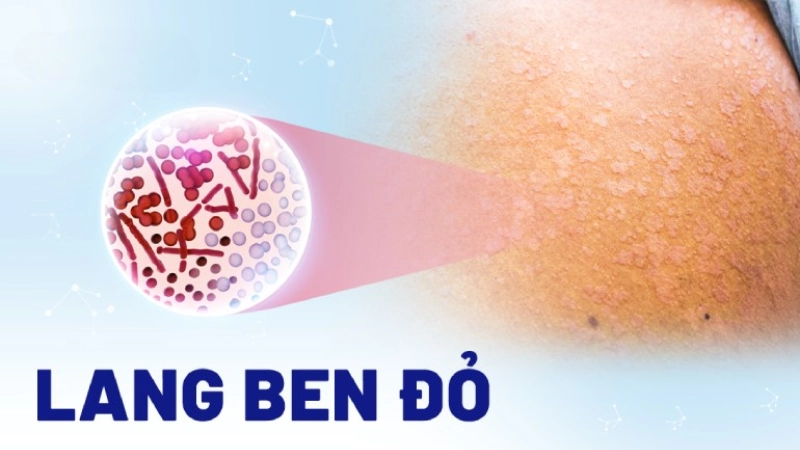 Hình ảnh bệnh lang beng đỏ là như thế nào