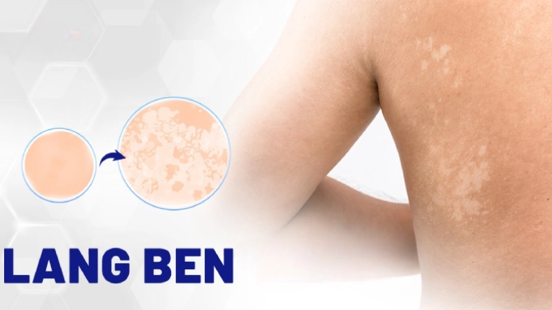 Lang beng là như thế nào mà khiến ai cũng sợ hãi