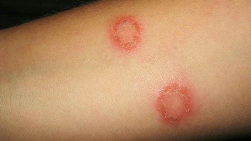 Khám phá hình ảnh bệnh lao da rõ nét cho người tìm hiểu