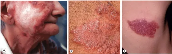 Khám phá ảnh tổn thương bệnh lao da chân thực minh họa