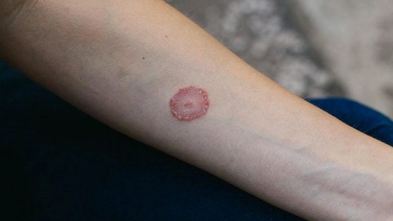 Cập nhật dấu hiệu benh lao da qua ảnh minh họa dễ hiểu