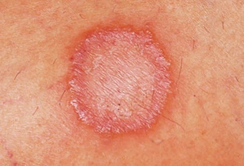 Chi tiết hình ảnh vết loét lao da giúp nhận diện bệnh sớm