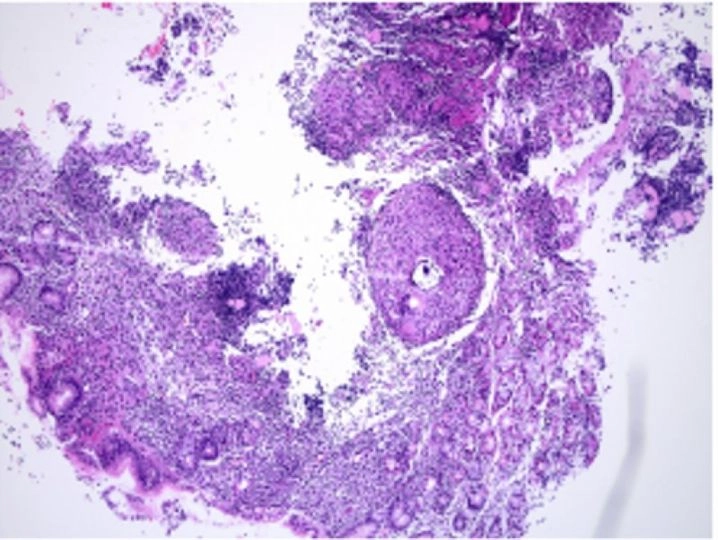 Nhận biết triệu chứng bệnh lao da qua ảnh rõ ràng thực tế
