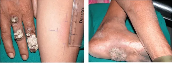 Xem minh họa thực tế từ ảnh người bị lao da để hiểu bệnh