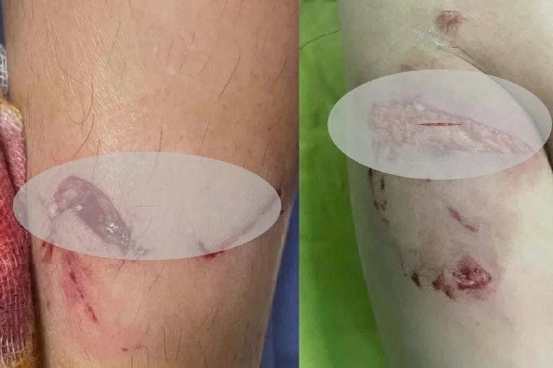 Xem rõ triệu chứng qua hình ảnh bị bệnh hắc lào thực tế