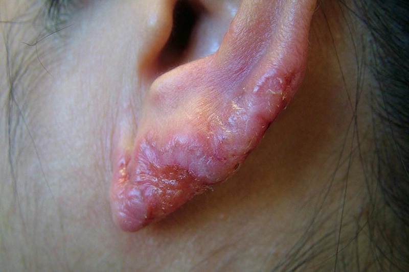 Tìm hiểu dấu hiệu hình ảnh người bị hắc lào dễ nhận biết