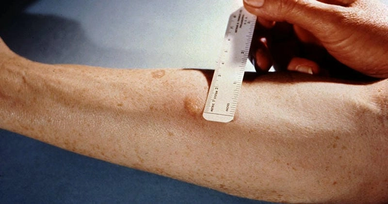 Cập nhật bộ sưu tập ảnh bị hắc lào minh họa cụ thể