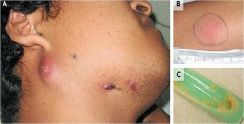 Tổng hợp các loại ảnh hắc lào giúp phân biệt bệnh sớm