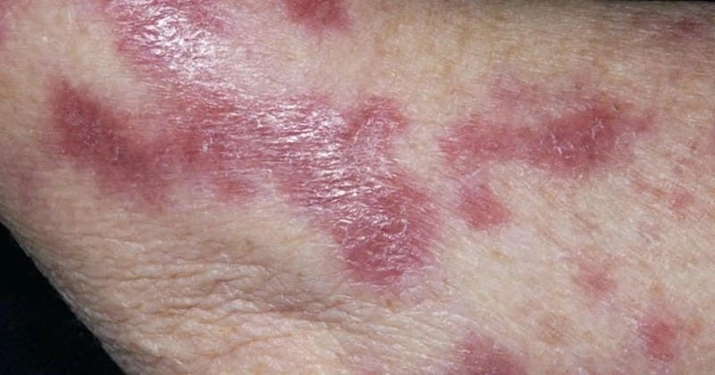 Bộ sưu tập chân thực về ảnh bệnh lao da dễ nhận biết