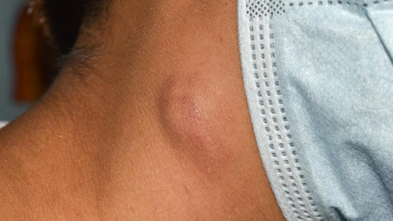 Nhận biết qua hình ảnh người bệnh lao da chân thực rõ nét