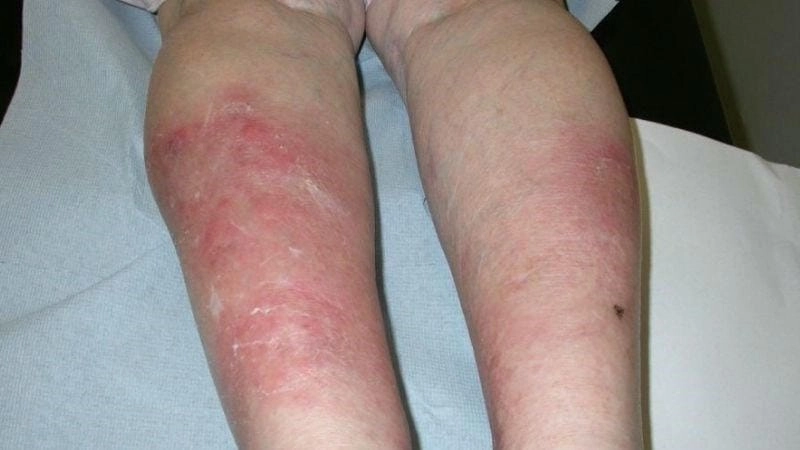 Tổng hợp ảnh người bệnh lao da minh họa thực tế sinh động