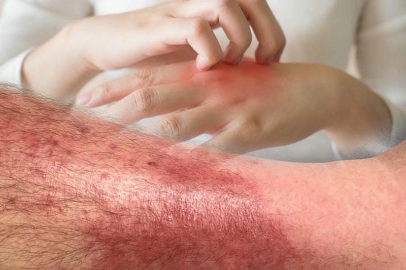 Thông tin trực quan qua ảnh người bị bệnh lao da dễ hiểu