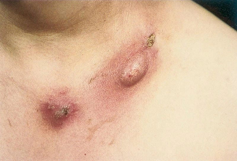 Thông tin nhận biết bệnh lao da kèm hình minh họa chi tiết