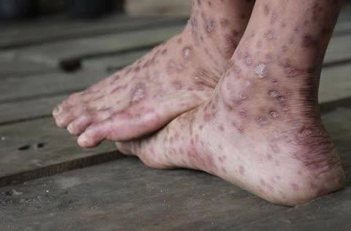 Khám phá ảnh vết thương lao da thực tế để hiểu rõ triệu chứng