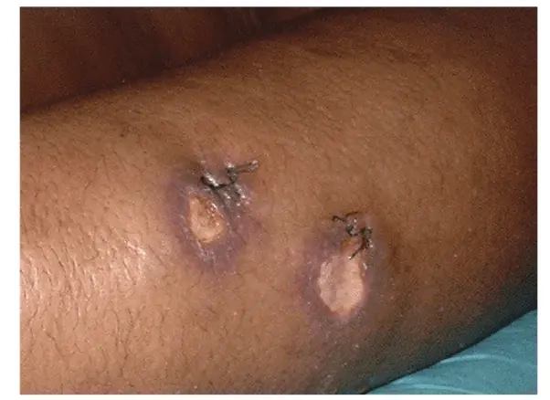 Cập nhật hình ảnh lao da ở người lớn minh họa nhận biết bệnh