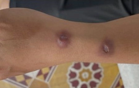 Cập nhật hình ảnh biến chứng bệnh lao da để phòng tránh kịp thời