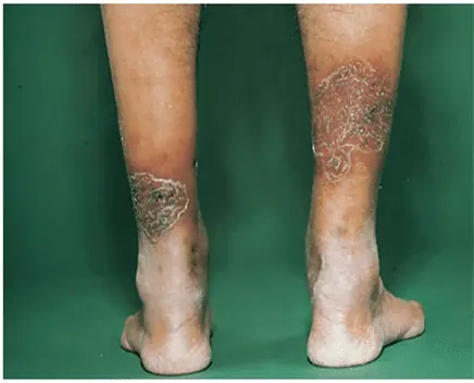 Chi tiết hình ảnh bệnh lao da ở chân minh họa thực tế rõ ràng