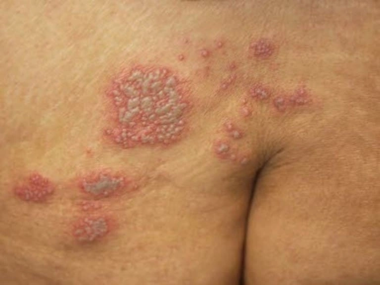 Tổng hợp hình ảnh bệnh lao da giai đoạn đầu chuẩn xác nhất