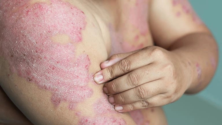 Xem ngay hình ảnh bệnh lao da ở tay để dễ nhận biết dấu hiệu