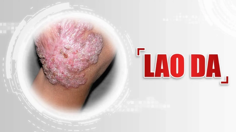 Hình ảnh bệnh lao da là như thế nào