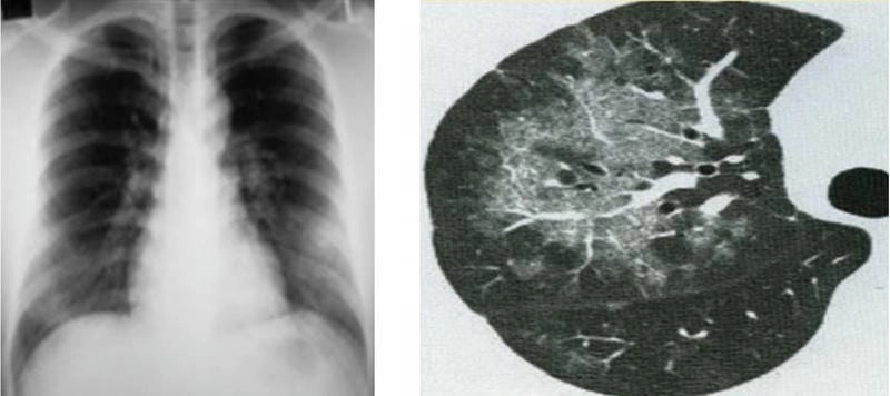 Xem xét chuyên môn với chẩn đoán hình ảnh lao phổi