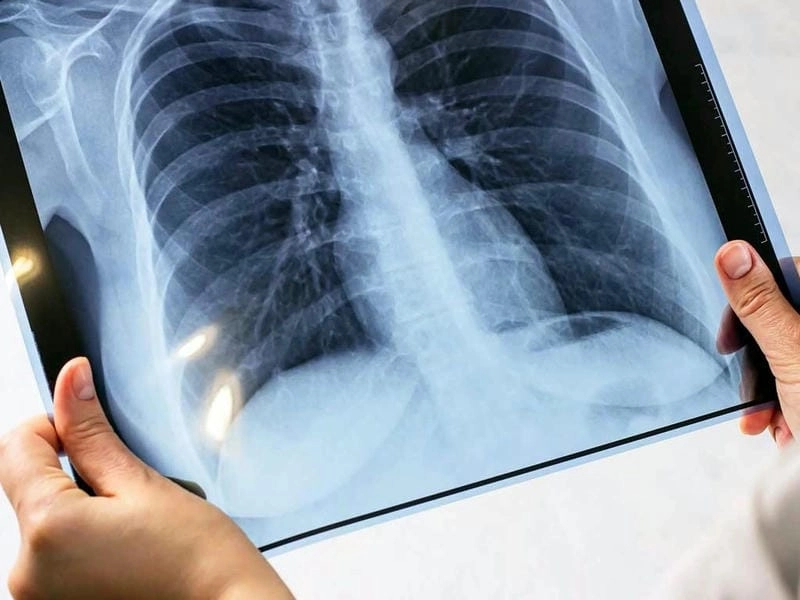 Khám phá y học qua hình ảnh bệnh lao sinh động