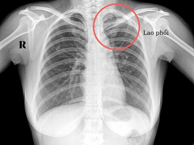 Phân biệt bệnh qua hình ảnh phổi bị lao chính xác