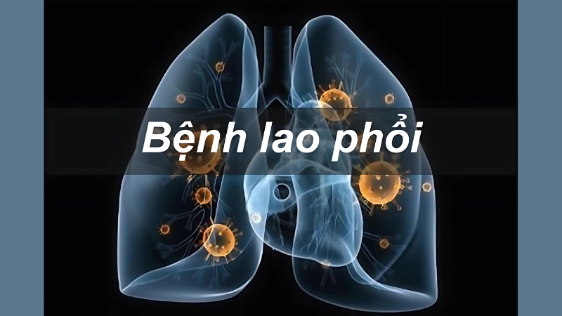 Hình ảnh bệnh lao phổi là như thế nào