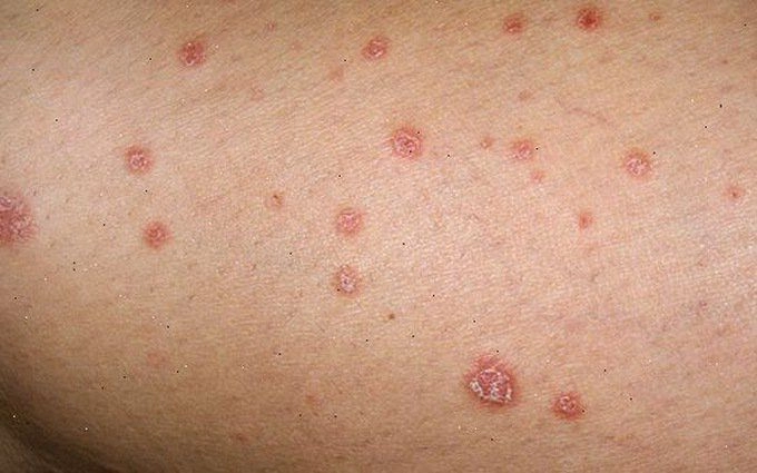 Khám phá hình ảnh bệnh lậu ở nam thực tế và dễ nhận biết