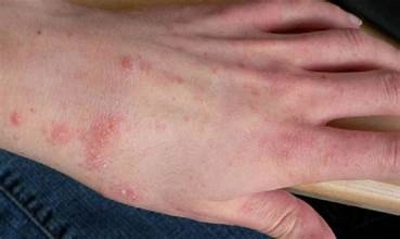 Nhận biết triệu chứng qua hình ảnh bệnh lậu nam ban đầu