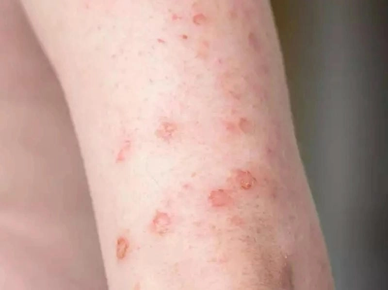 Nhận diện sớm hình ảnh dấu hiệu bệnh lậu ở nam giới dễ thấy