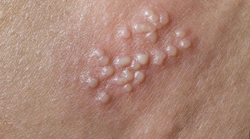 Chẩn đoán sớm với dấu hiệu hình ảnh bệnh lậu ở nam