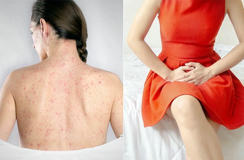 Cập nhật rõ nét các hình ảnh bệnh lậu nữ dễ nhận biết