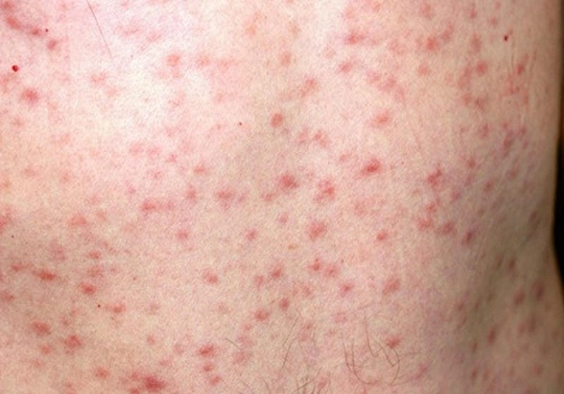 Xem kỹ các hình ảnh bệnh lậu giang mai dễ gây nhầm lẫn