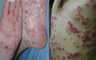 Khám ngay hình ảnh bệnh hình ảnh bệnh lậu