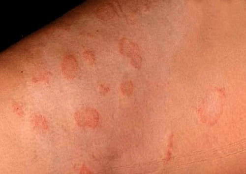 Nhận biết sớm hình ảnh bệnh lậu ở lưỡi