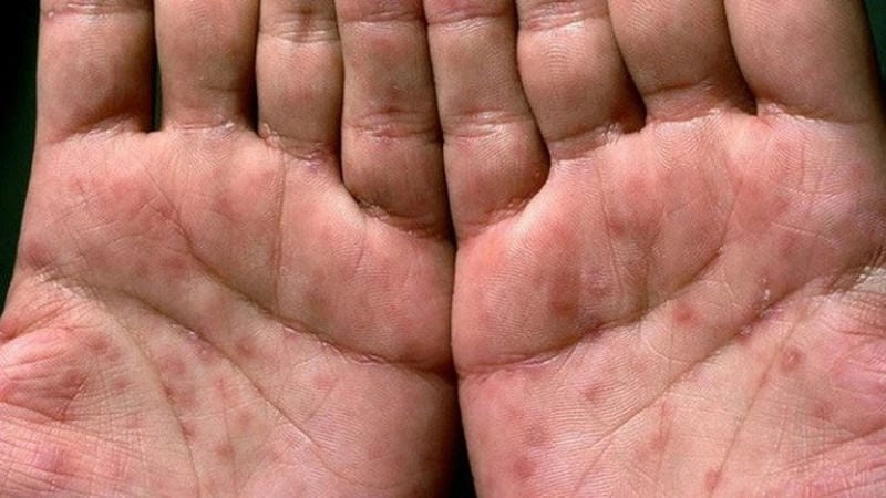 Xem chi tiết bệnh lậu ở nam hình ảnh thật