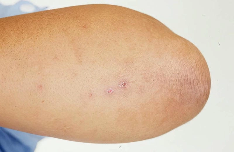 Tìm hiểu kỹ các loại ảnh bệnh lậu được cập nhật mới