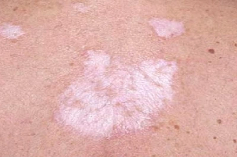 Cảnh báo sớm từ hình ảnh bệnh lichen và tình trạng lichen xơ hoá