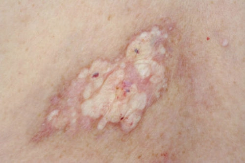 Nhận diện hình ảnh bệnh lichen liên quan lichen xơ hóa