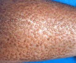 Xem ngay hình ảnh bệnh lichen để nhận biết liken hoá