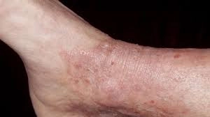 Chi tiết hình ảnh bệnh lichen ở vùng có mảng lichen hóa