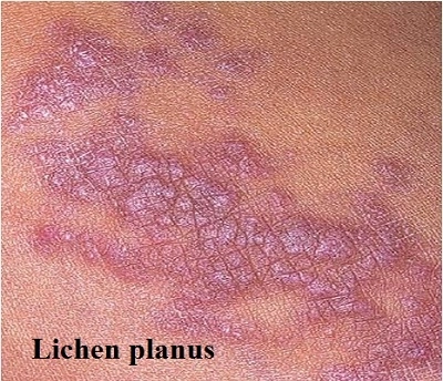 Tìm hiểu hình ảnh bệnh lichen và bệnh lichen planus