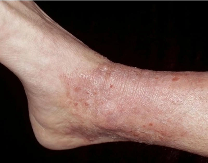 Đừng bỏ qua hình ảnh bệnh lichen của bệnh lichen amyloidosis