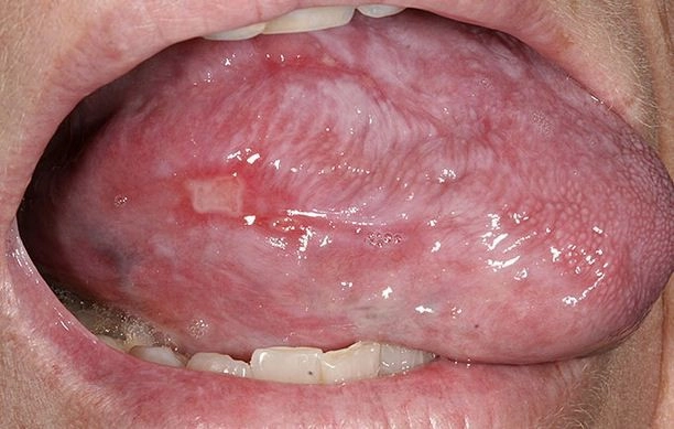 Phát hiện hình ảnh bệnh lichen điển hình ở bệnh lichen phẳng ở lưỡi