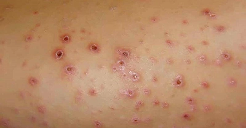 Hình ảnh bệnh lichen thường gặp là bệnh lichen amyloidosis