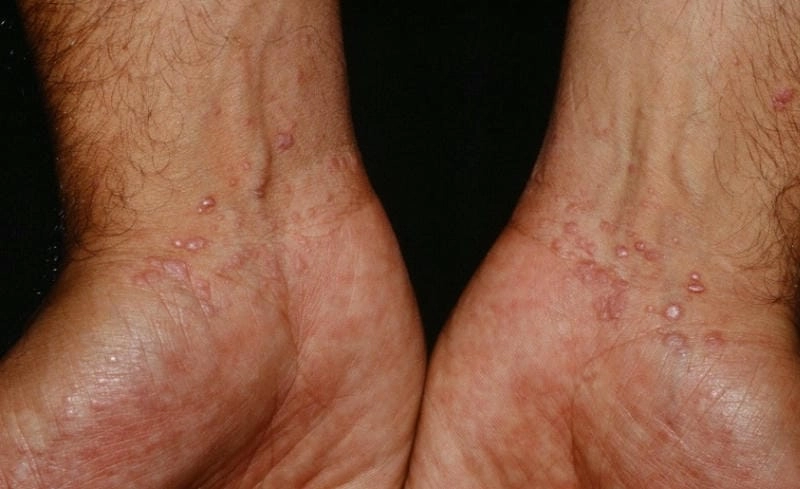 Phát hiện sớm qua hình ảnh bệnh lichen và hình ảnh bệnh lichen amyloidosis