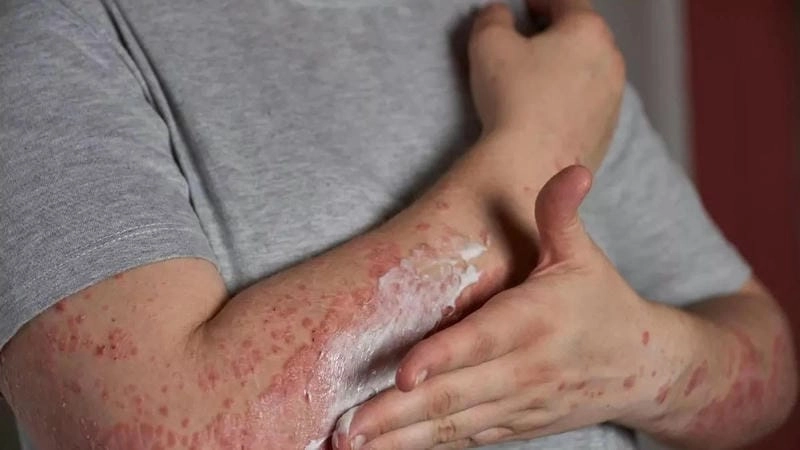 Xem hình ảnh bệnh lichen để hỗ trợ chữa bệnh lichen amyloid