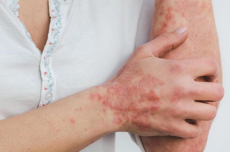 Cẩn thận với hình ảnh bệnh lichen liên quan lichen hoá da