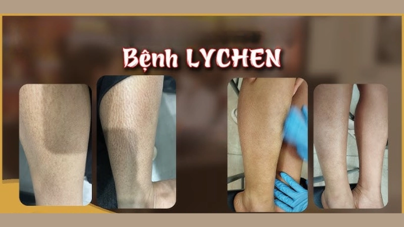 Hình ảnh bệnh lichen là như thế nào